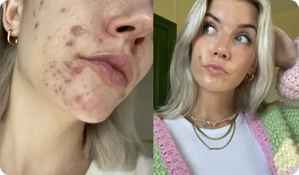 "Stopping the pill was a nightmare"