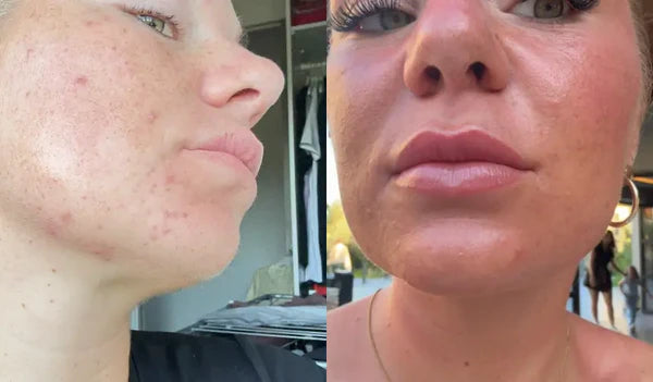 "My chin is finally calm"