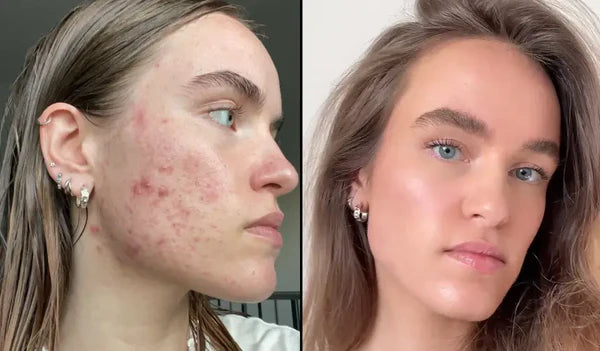 "Finally something that works for hormonal acne"