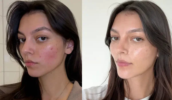 "Stress acne was my problem"