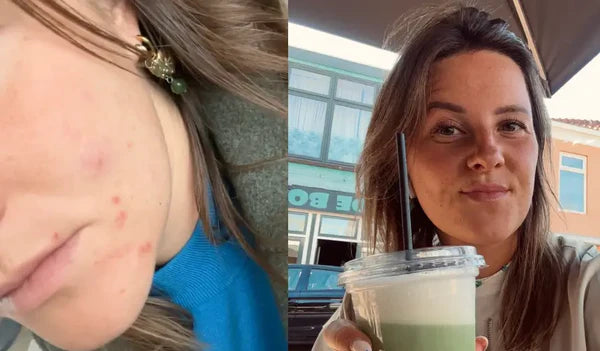 "After stopping the pill my skin exploded"