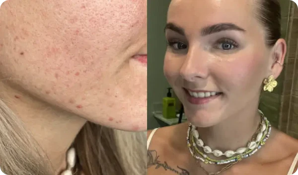 "The red spots disappear faster"