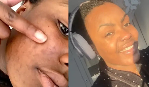 "It started with less sebum"