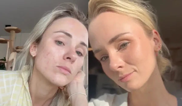 "The red spots disappear faster"